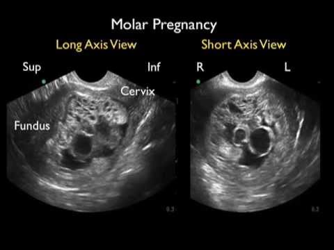 Ultrasound Detection of a Molar Pregnancy in the Emergency Department