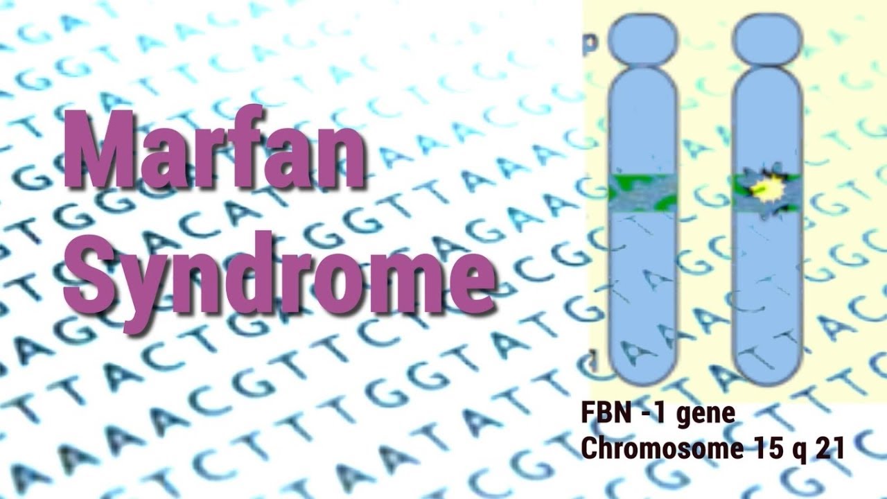 Marfan Syndrome | Heart, Skeletal & Eye Complications | Connective Tissue Disorder