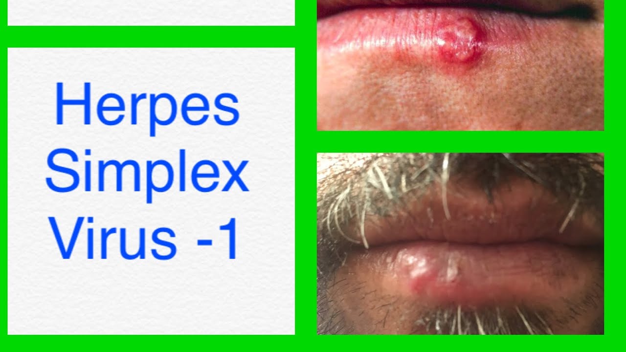 Cold Sores
