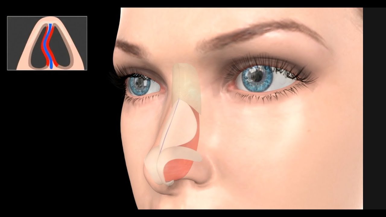 Deviated Septum Surgery (Septoplasty)