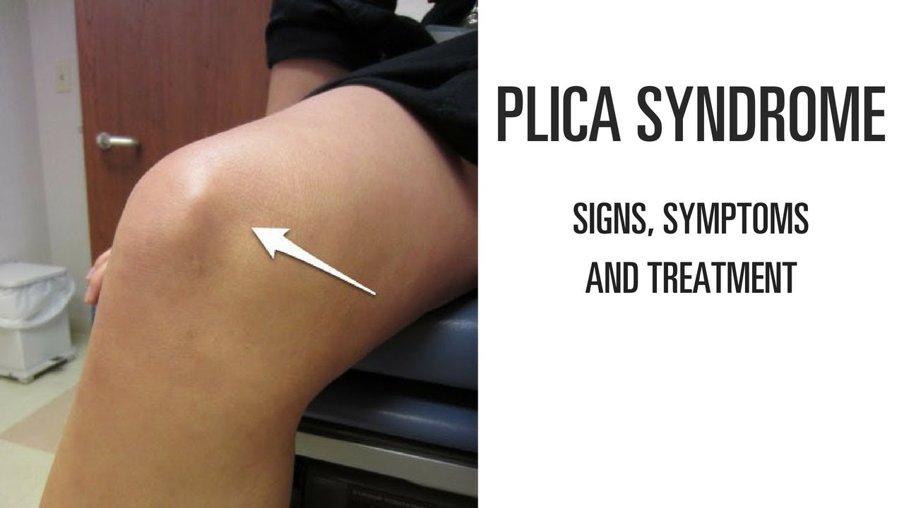 Plica syndrome: Signs, symptoms and treatment of this uncomfortable knee pain