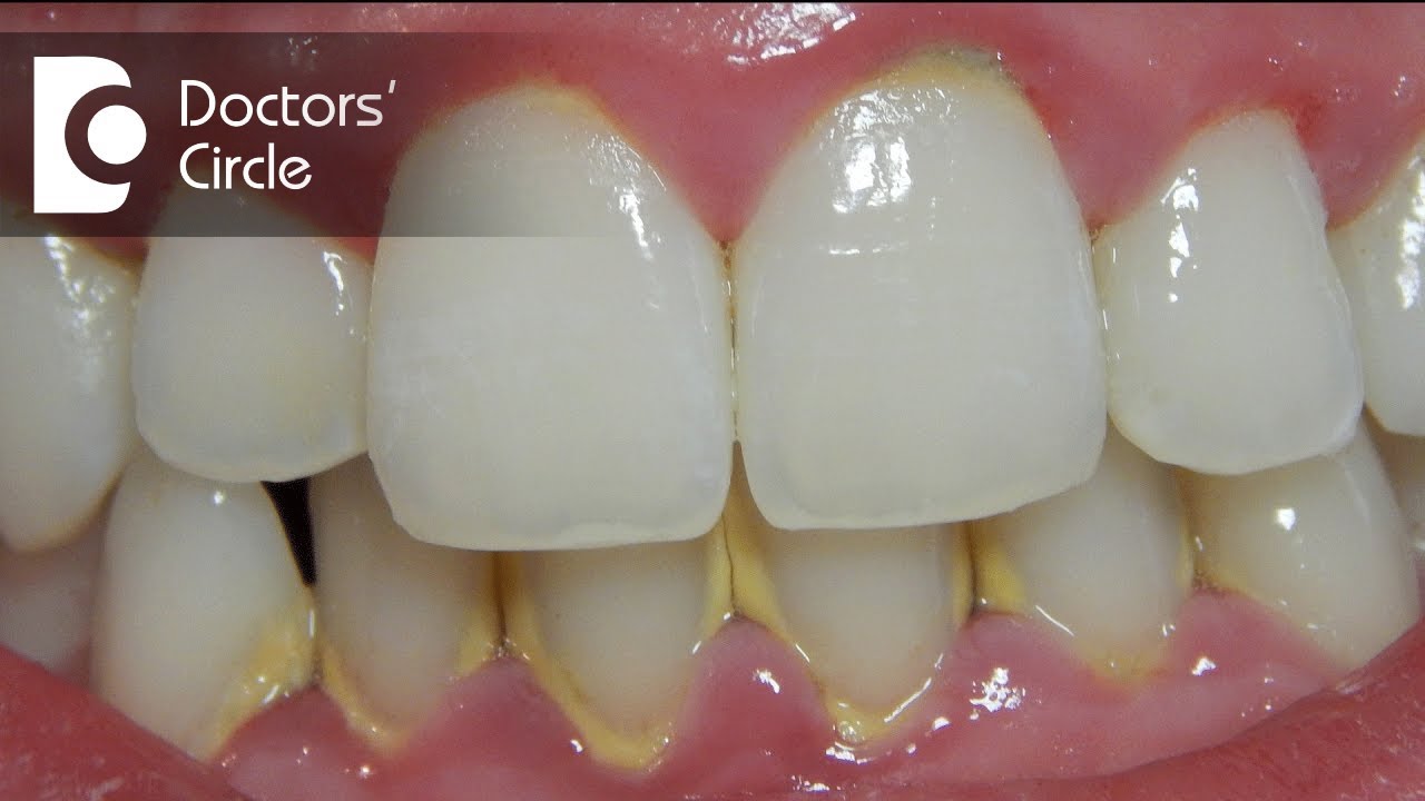What is Gingivitis & its causes? - Dr. Abhishek Bhadranna