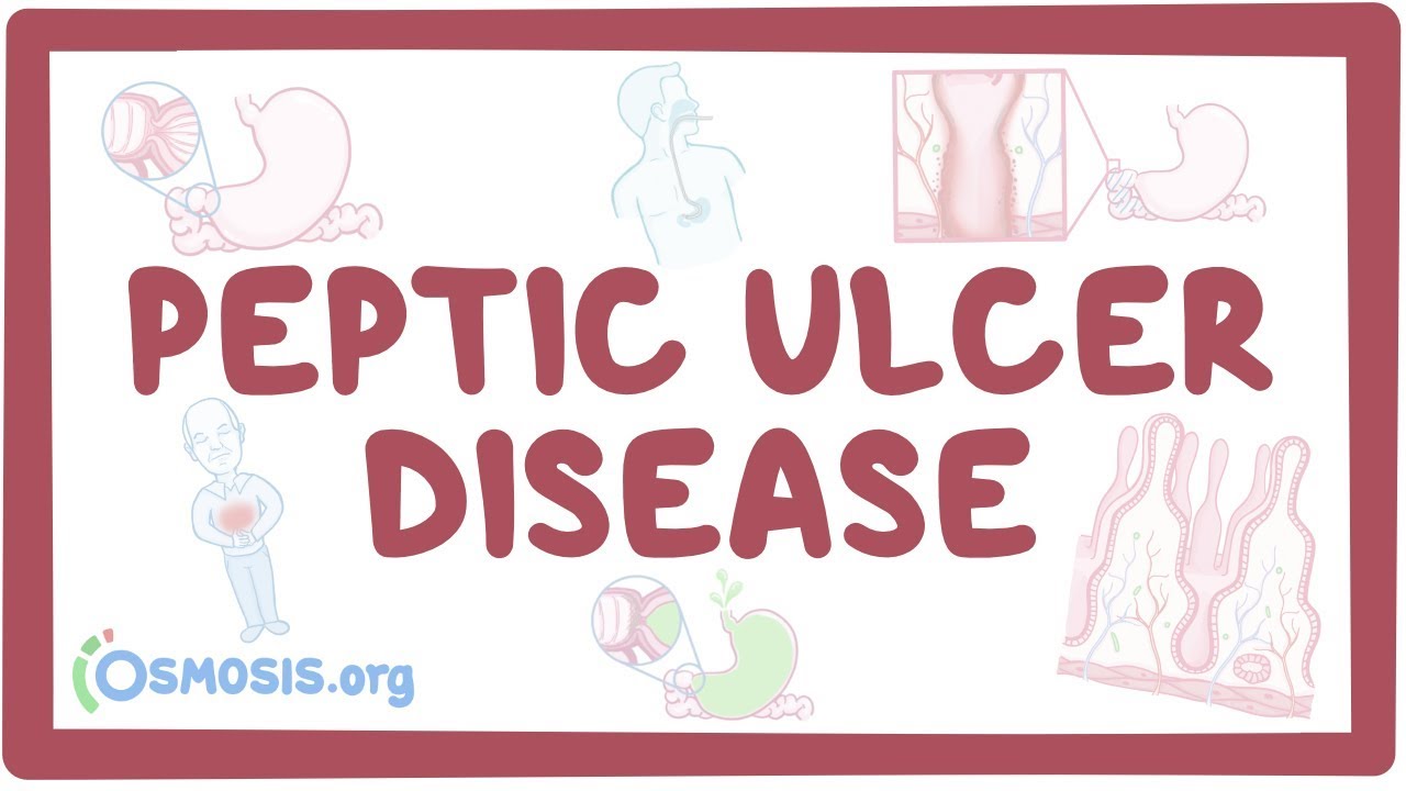 Peptic ulcer disease - causes, symptoms, diagnosis, treatment, pathology