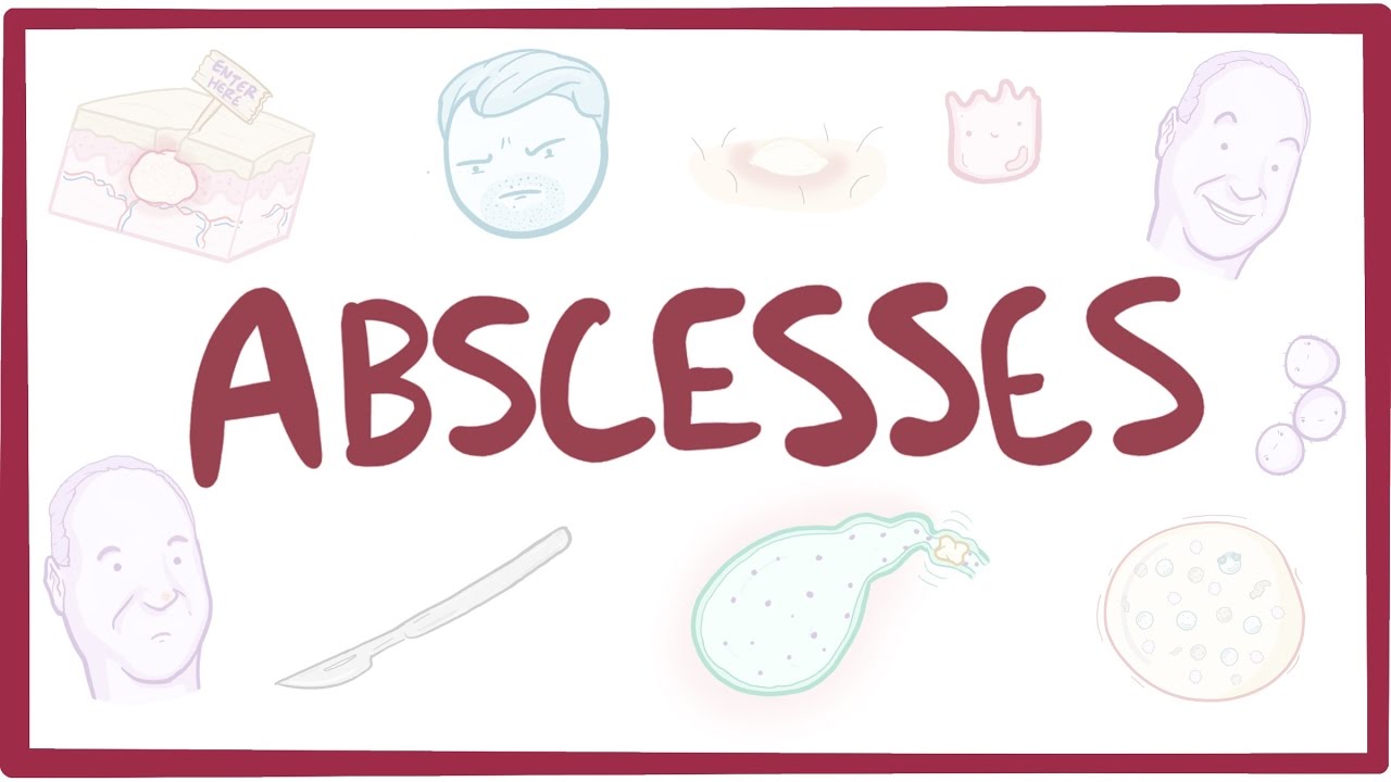 Abscesses - causes, symptoms, diagnosis, treatment, pathology