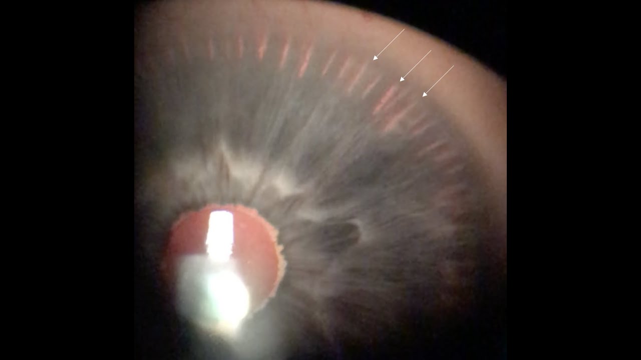 1 Slide in 5 Minutes: Pigment Dispersion Syndrome and Pigmentary Glaucoma (Malik Y. Kahook, MD)