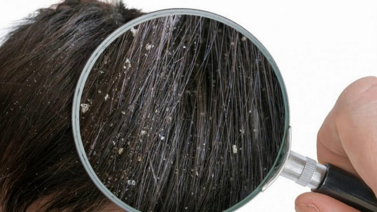 Difference Between Lice and Dandruff