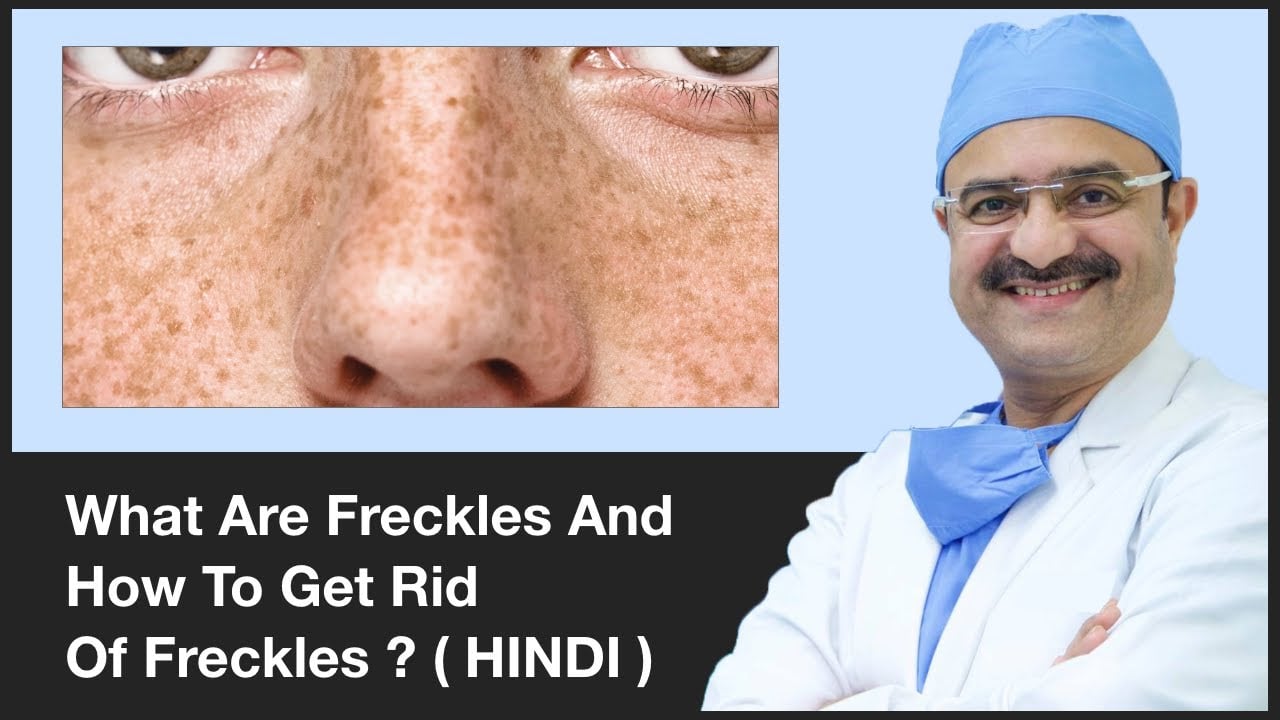 What Are Freckles And How To Get Rid Of Freckles | ClearSkin, Pune | (In HINDI)