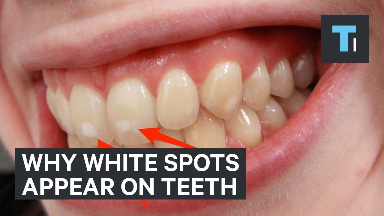 Here's why some people have white spots on their teeth