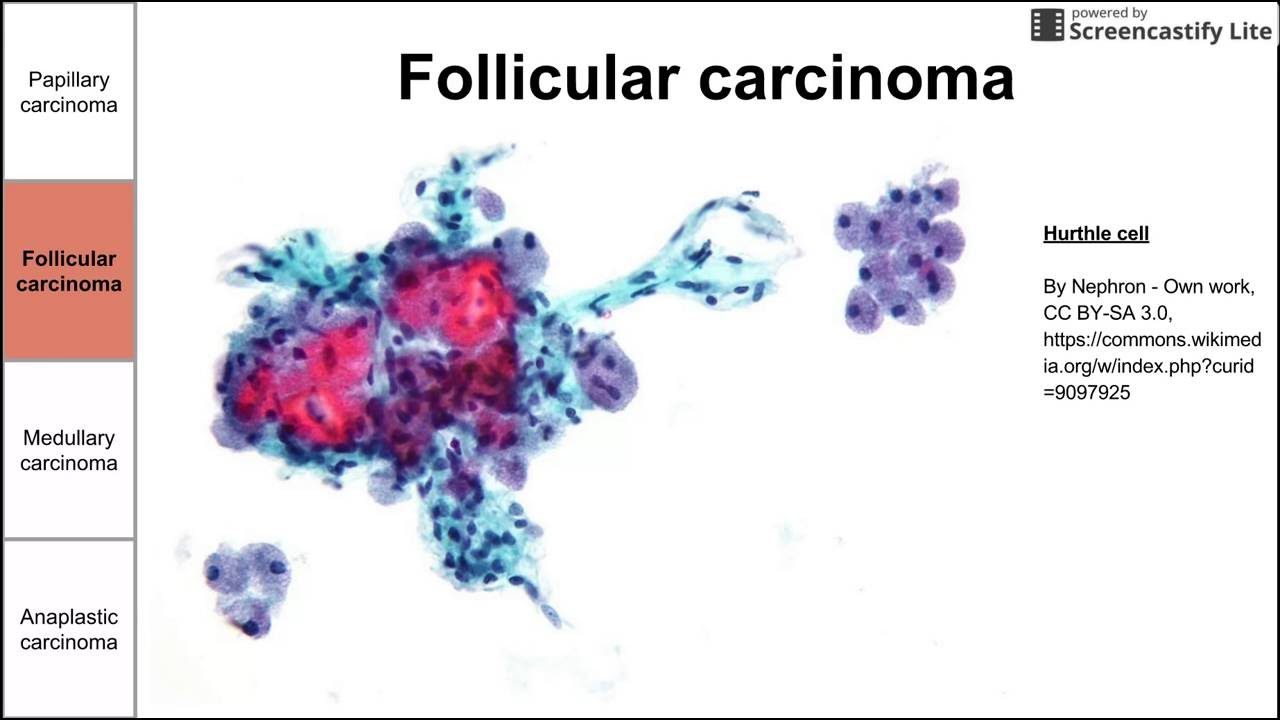 Thyroid Cancers