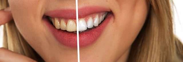 black lines on teeth