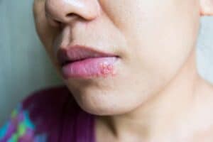 10 Famous People With Herpes