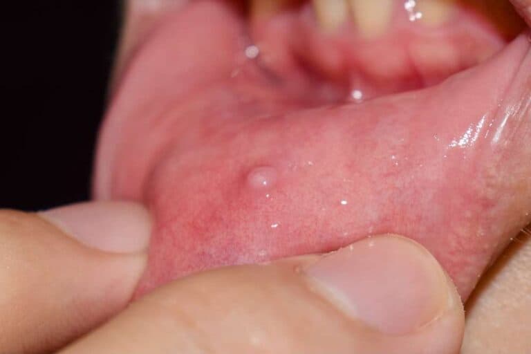 roof-of-mouth-hurts-8-possible-causes-icy-health