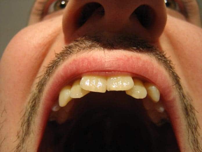 8 Interesting Causes Of A Roof Of Mouth Sore Icy Health