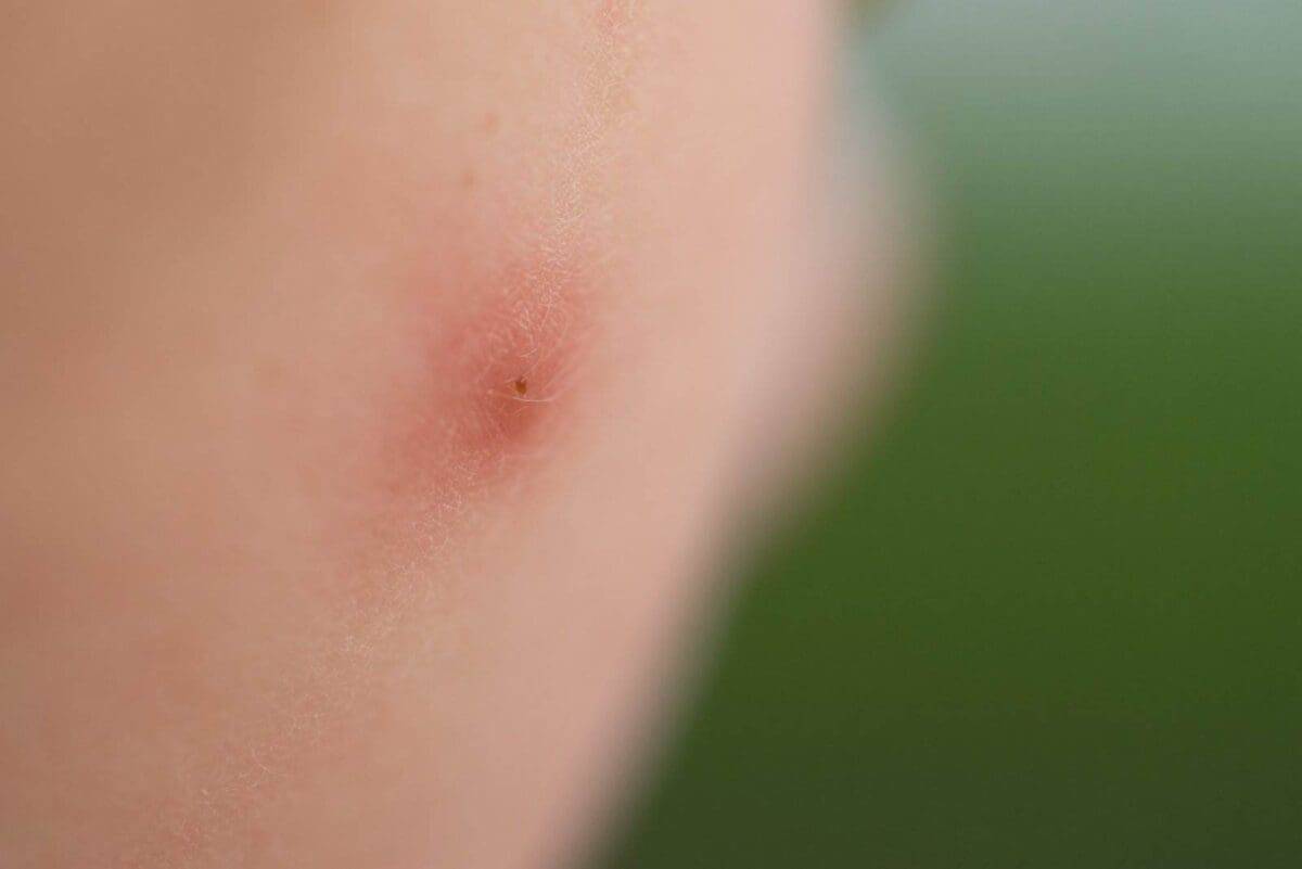 What Are Black Fly Bites 101 Guide What Are Black Fly Bites 101 Guide