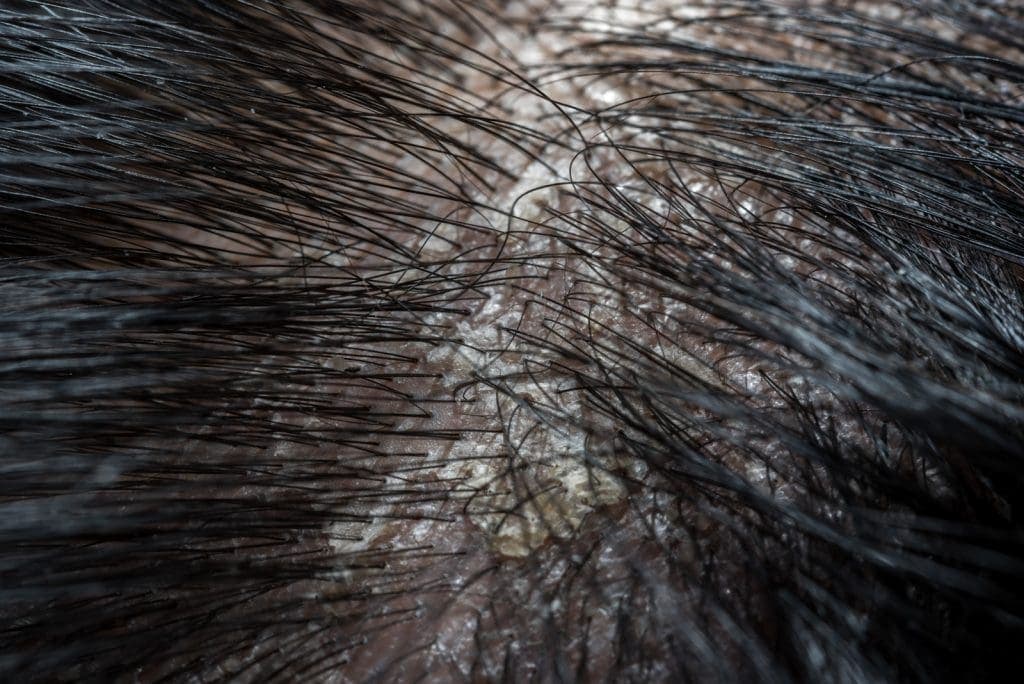 What Causes Dry Scalp? 5 Major Reasons Explained
