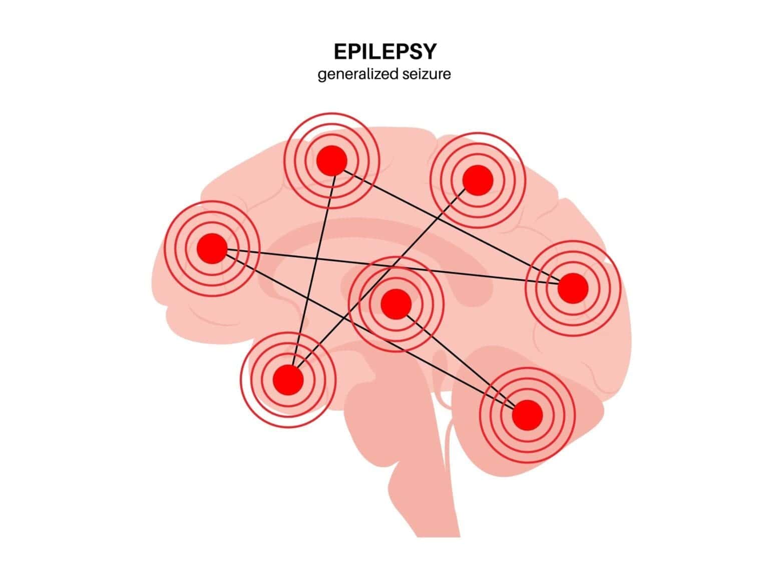 can-you-die-from-a-seizure-understanding-the-risks