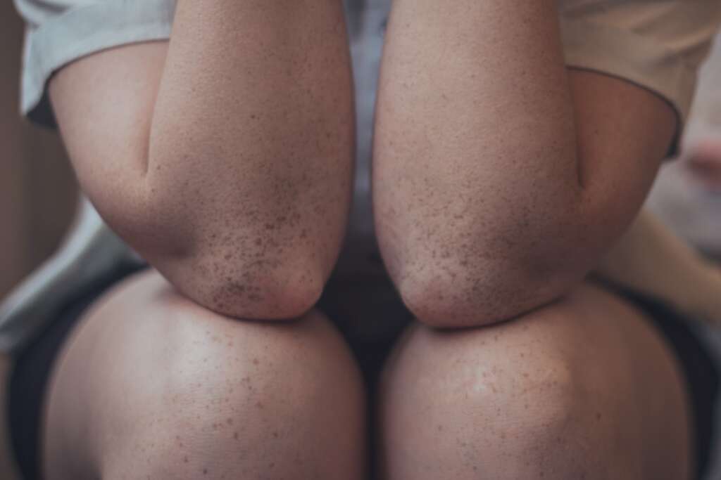 Elbows and Knees with freckles.