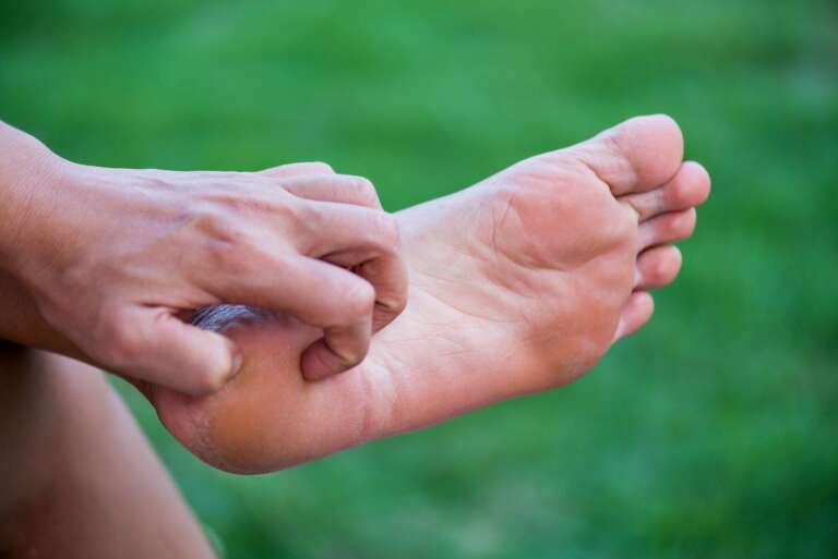 14 Home Remedies For Burning Feet Natural Relief