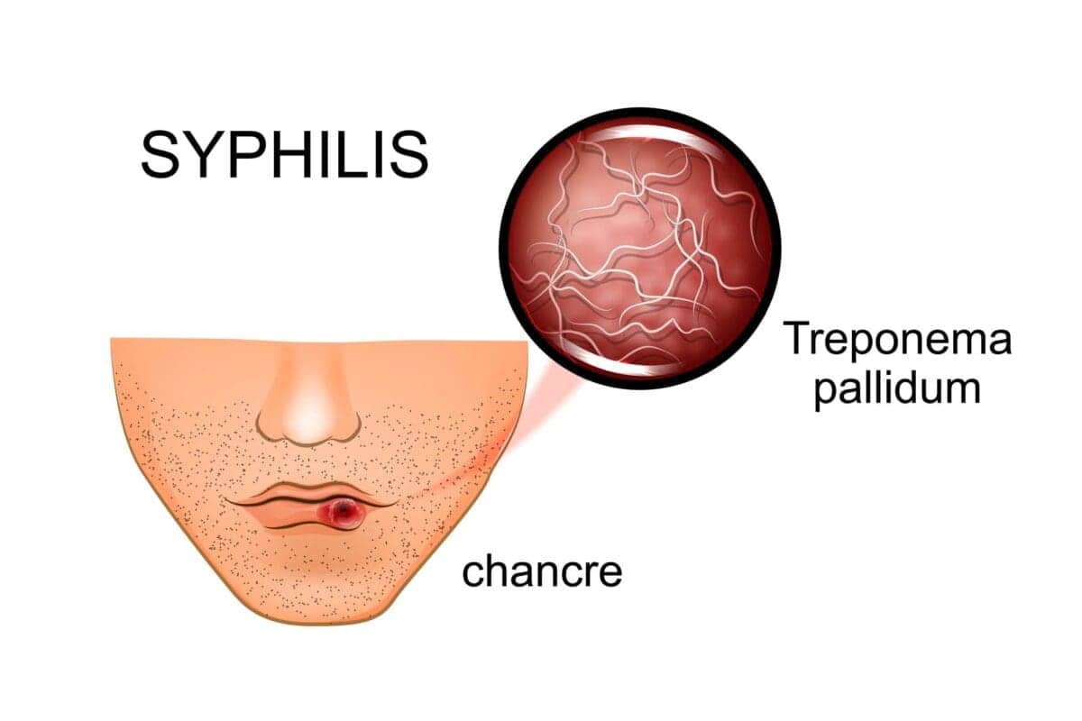 syphilis